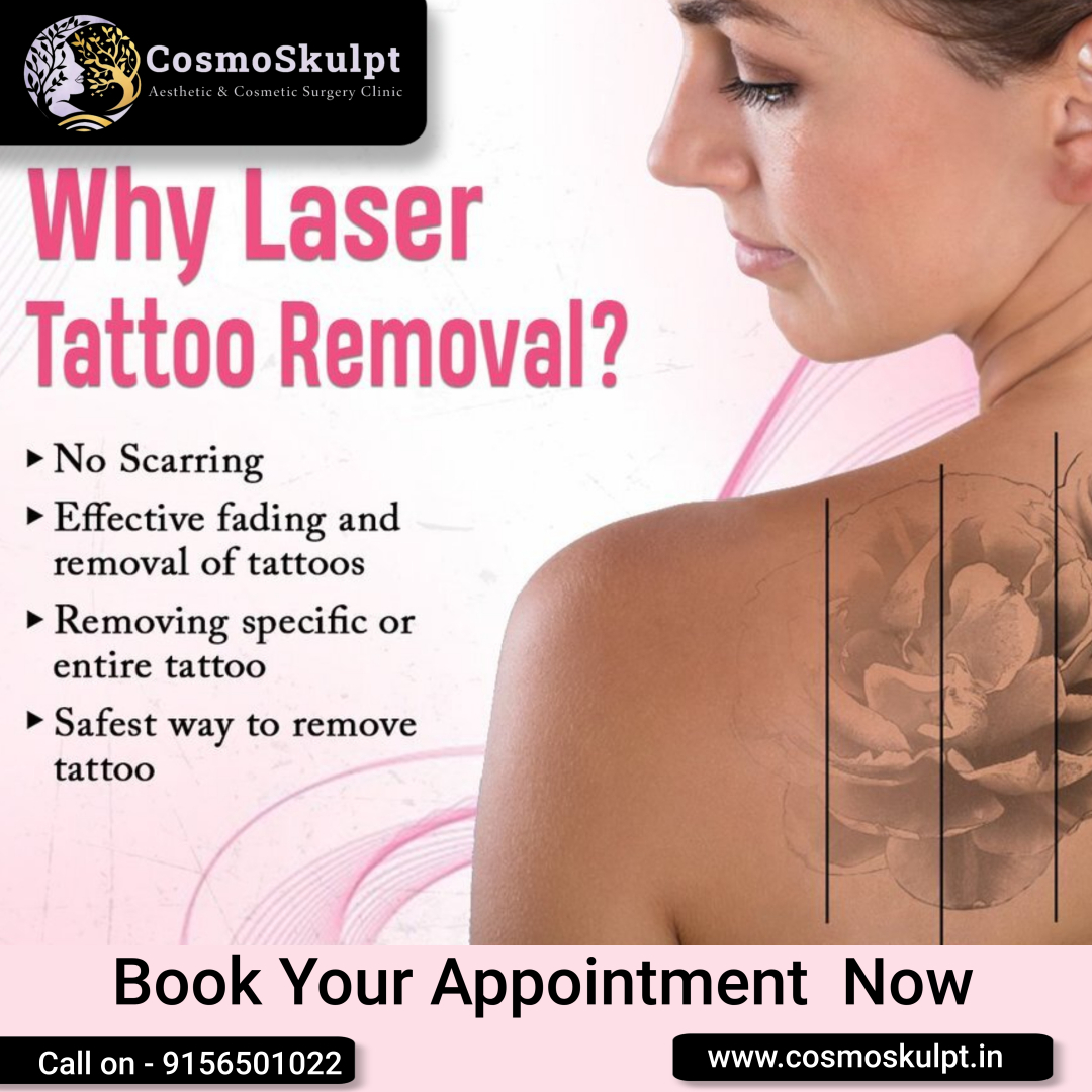 Unlock the Freedom of Bare Skin: Choose Laser Tattoo Removal! 