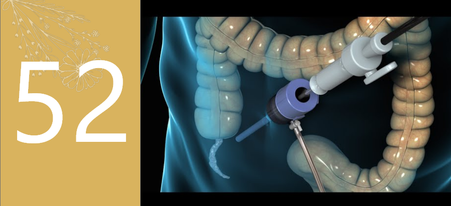 Laparoscopic Appendix Surgery