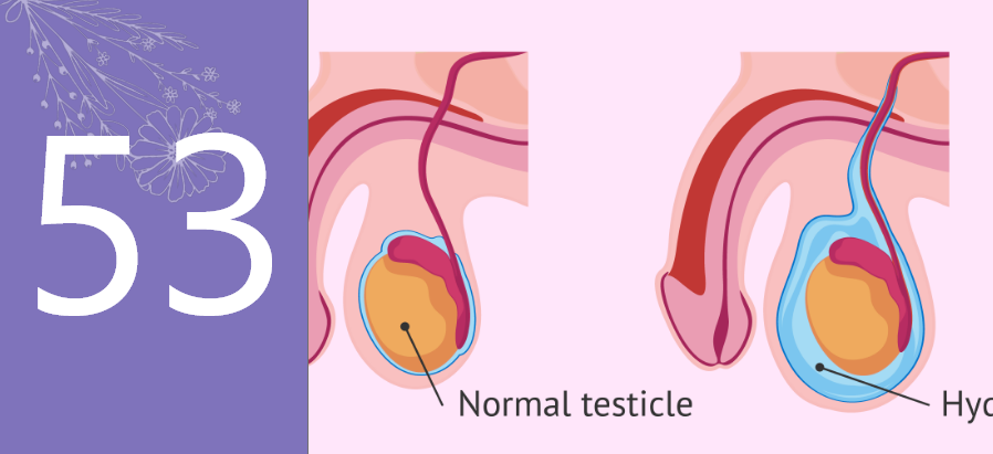 Hydrocele Surgery