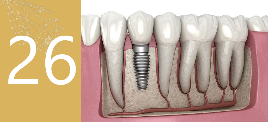 Dental implants