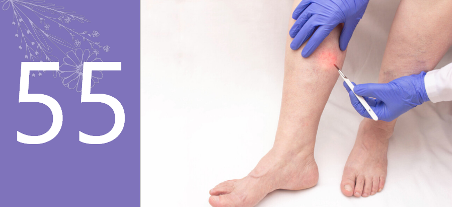 Laser Varicose Veins Surgery