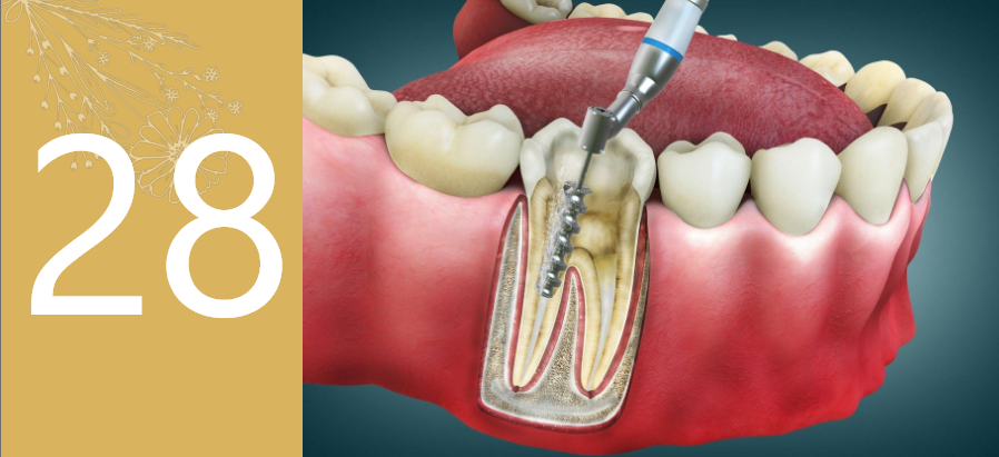 Root canal treatment