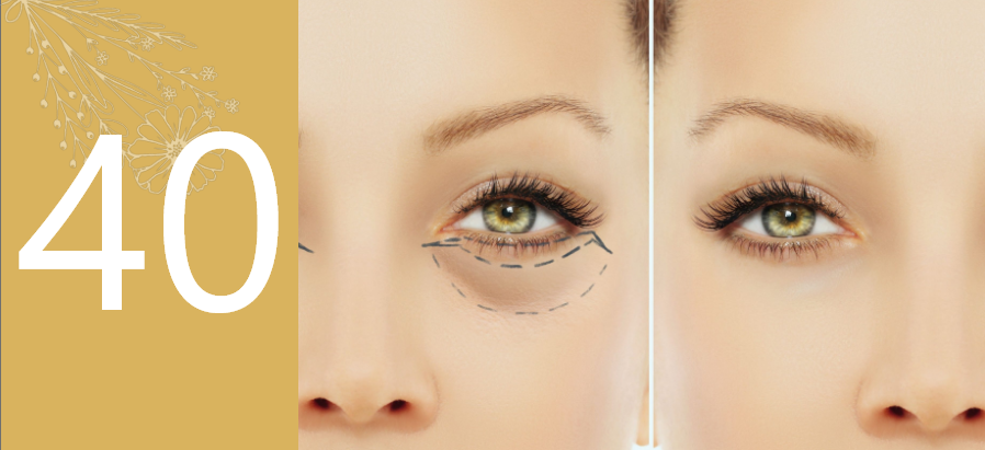 Blepharoplasty